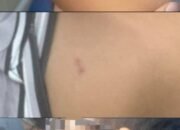 Penuh Memar dan Bekas Gigitan, Bocah Palembang Jadi Korban Kekerasan ART yang Dipercaya Keluarga