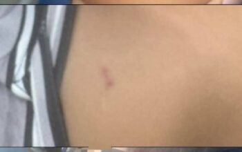 Penuh Memar dan Bekas Gigitan, Bocah Palembang Jadi Korban Kekerasan ART yang Dipercaya Keluarga